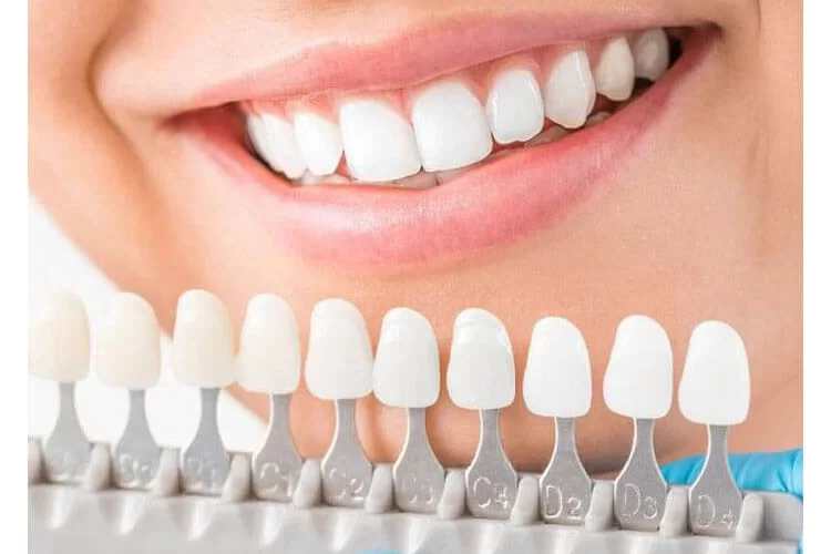 Подбор цвета коронки