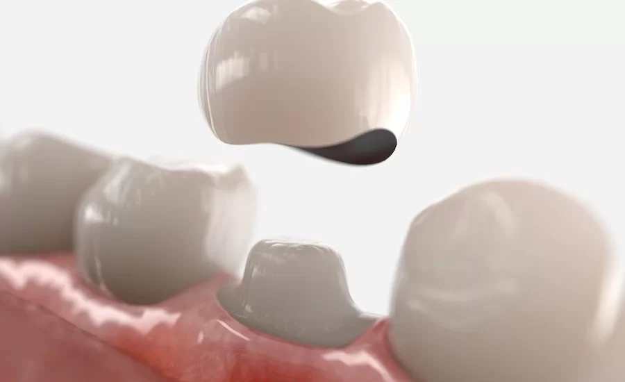 примерка коронки