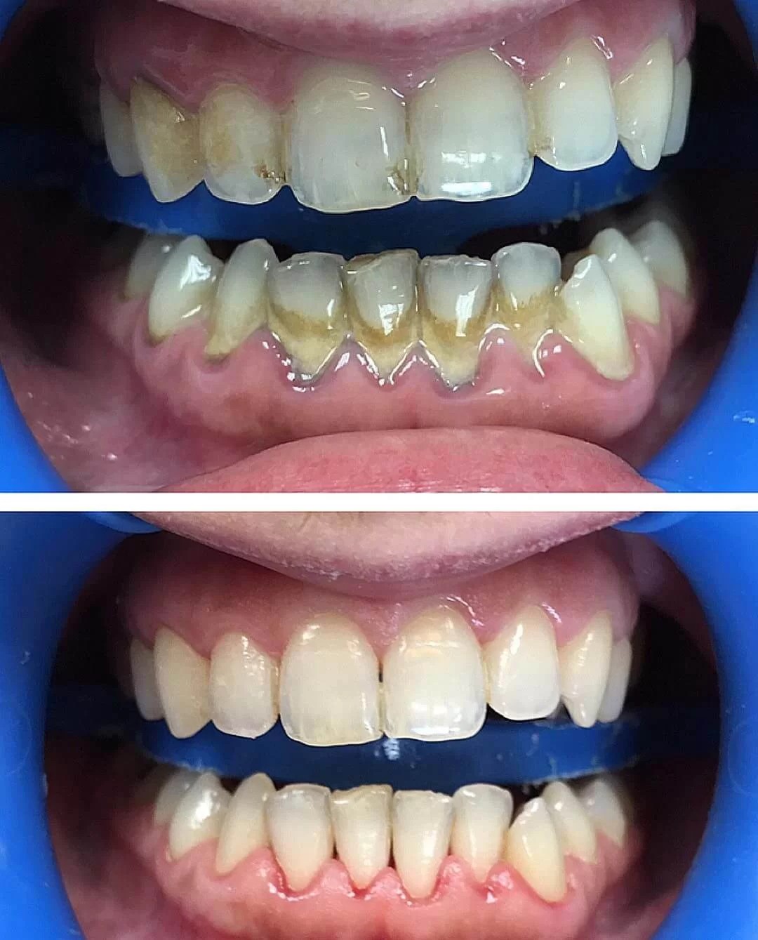 Зубной камень