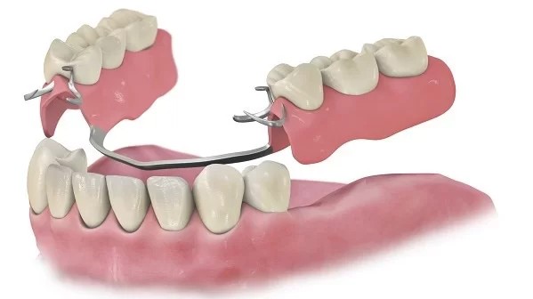 Съемный протез зубов