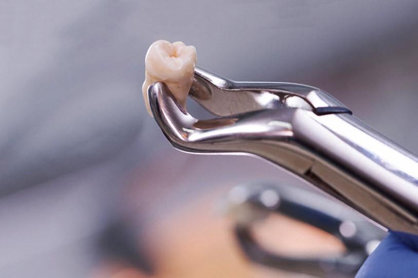 удаление зуба